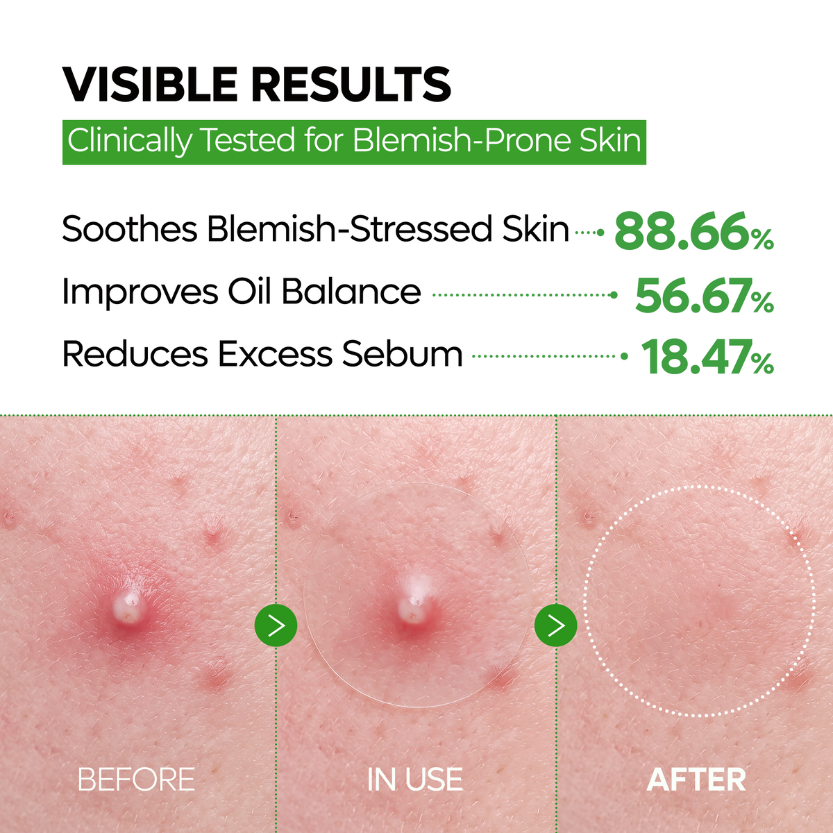 S-ZINC Zero-Fit Blemish Spot Patch